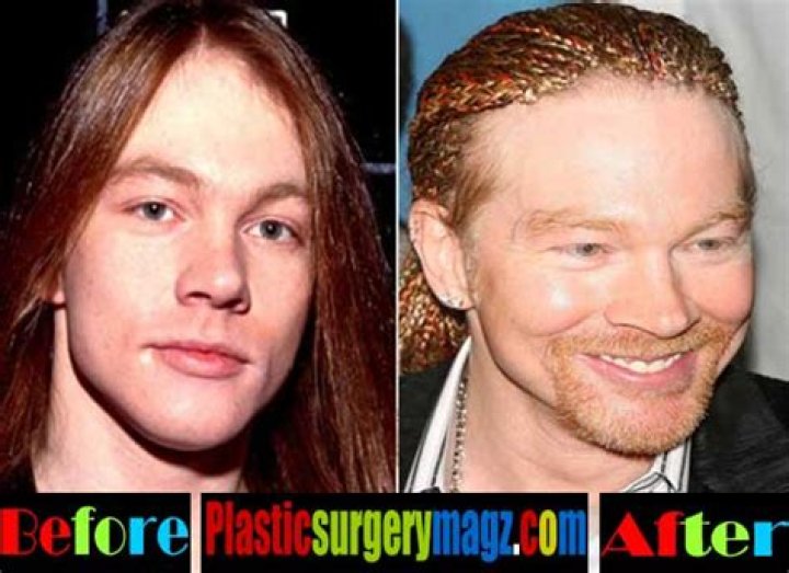 Axl Rose And His Journey Through Plastic Surgery: The Transformation Of A Rock Icon