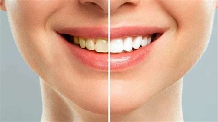 5 ways to get rid of yellow teeth – India TV