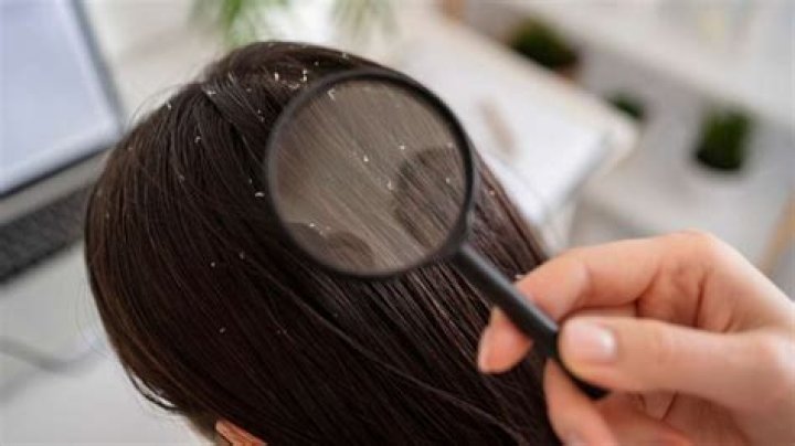 Can oil treat dandruff during winter? Pros and cons inside – India TV
