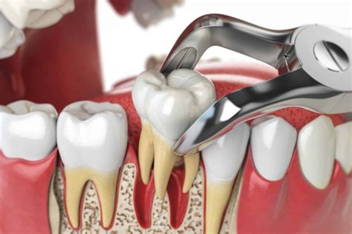 Question: Can You Remove Your Own Tooth