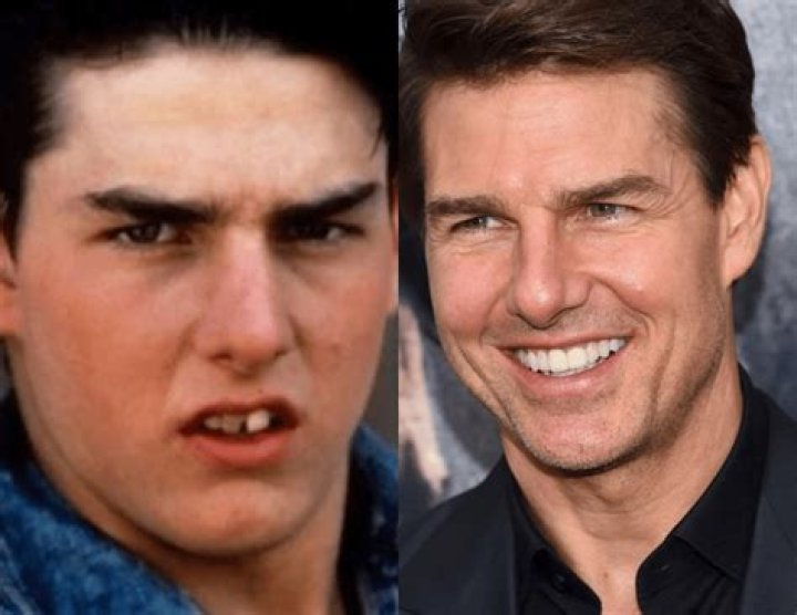 Embracing Imperfection: The Allure Of Celebrities With Crooked Teeth