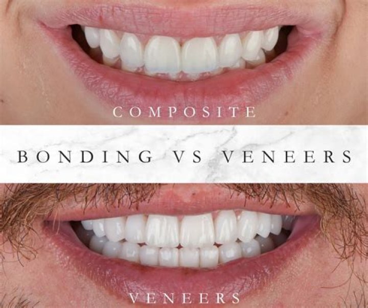 Composite Bonding, Explained And How It Differs From Veneers