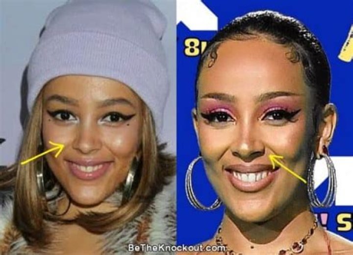 Unveiling The Truth Behind Doja Cat's Butt Surgery: What You Need To Know