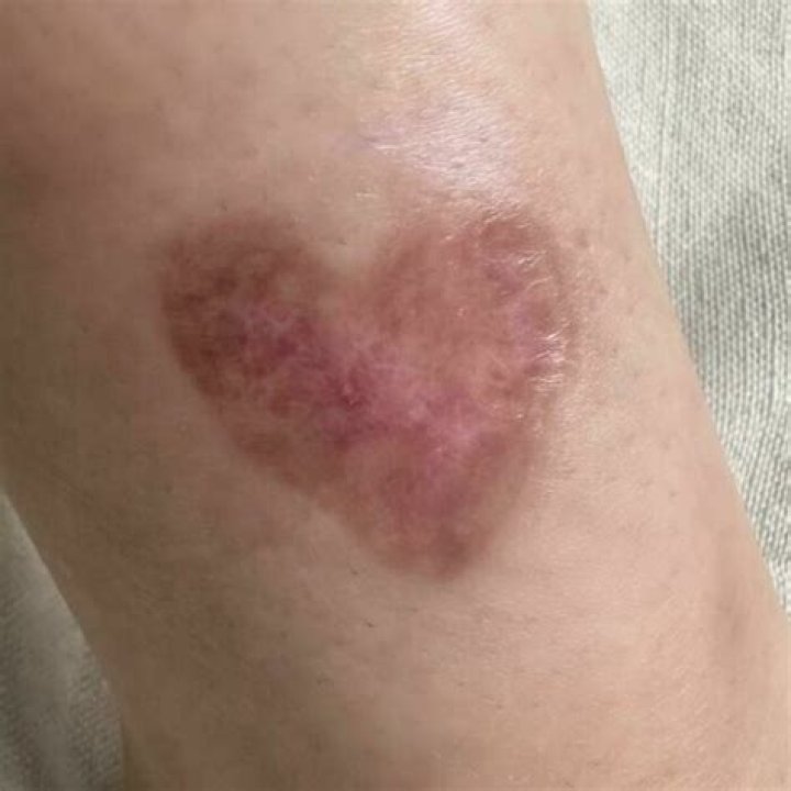 The Horrors Of Flesh-Eating Bug Bites: A Comprehensive Guide