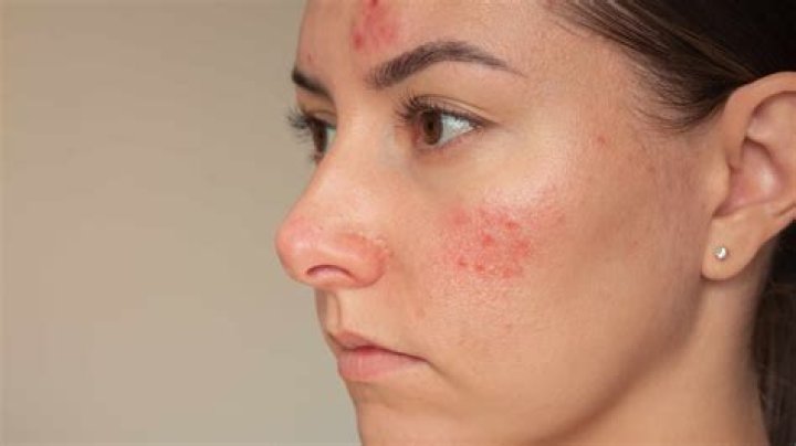 Unveiling The Mystery: How Did Beasteater Burn Her Face?
