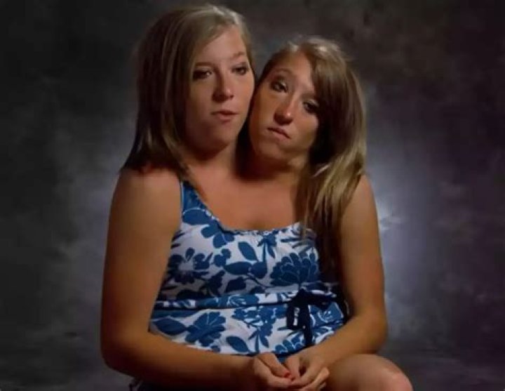 Unraveling The Mysteries: How Did Conjoined Twins Die?