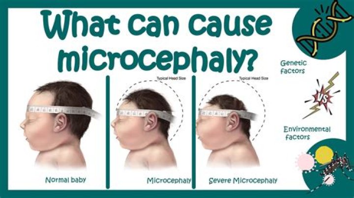 Question: How Long Do Babies With Microcephaly Live