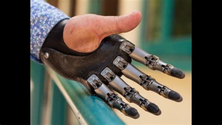 How Much Does A Prosthetic Finger Cost