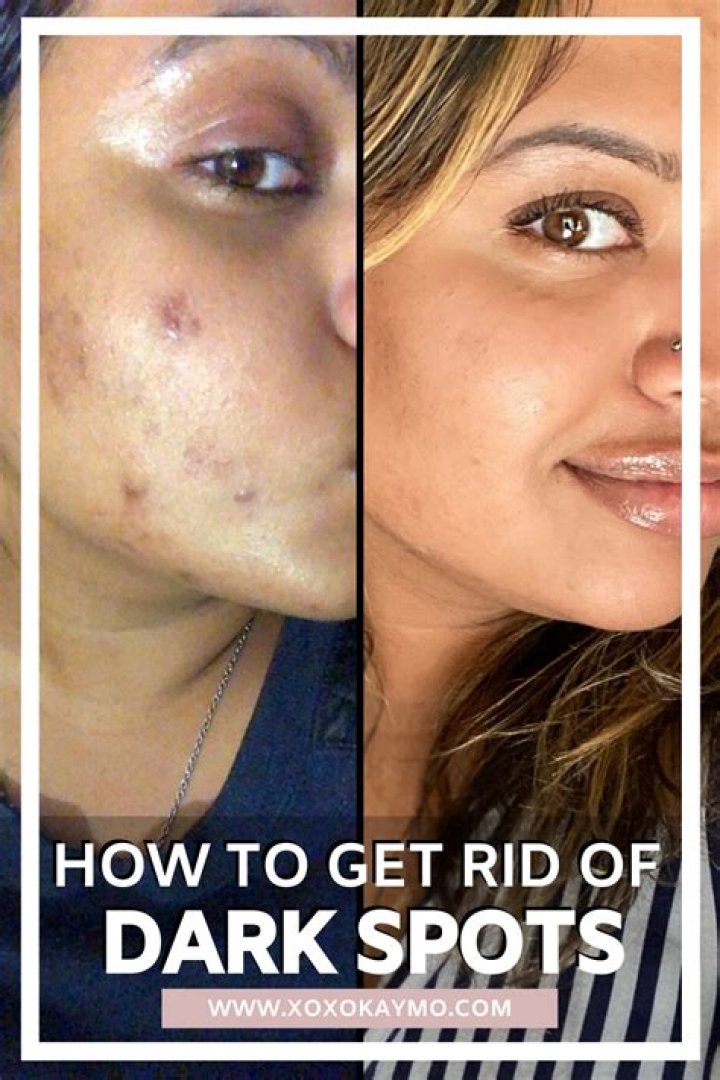 Ultimate Guide: How To Fade Dark Spots Effectively