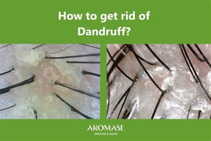 How To Get Rid Of Dandruff ASAP, According to Scalp Experts