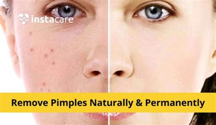 How To Remove Passion Marks