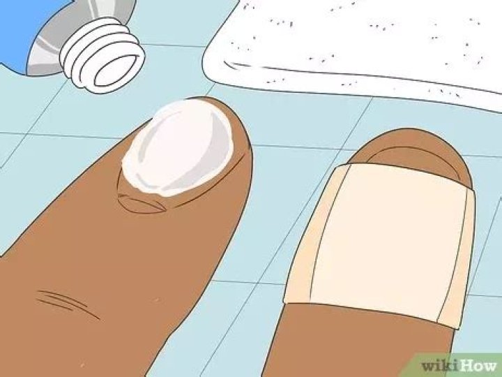 Question: How To Remove Splinter Under Fingernail