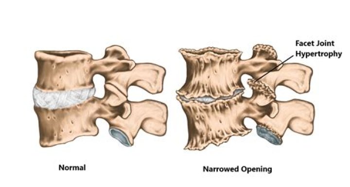 Understanding Hypertrophic Facets: Causes, Symptoms, And Treatment