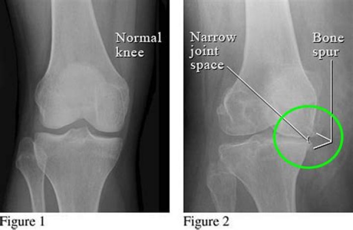 Understand Hypertrophic Spurs: Causes And Treatments