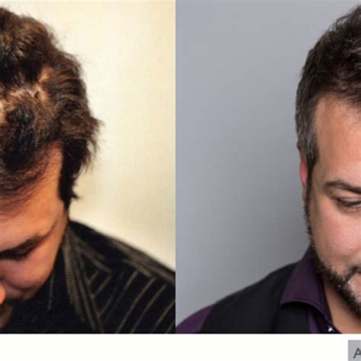 Joey Fatone's Hair Transplant Journey: A Celebrity's Path To Confidence