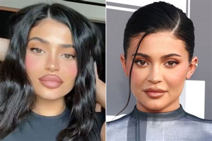 Kylie Jenner: The Transformation Before Lip Enhancements