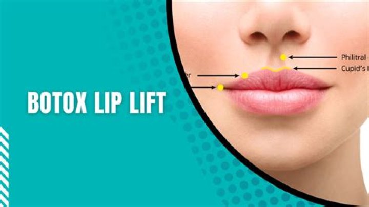 What's A Lip Lift? The Experts Explain Everything You Need To Know