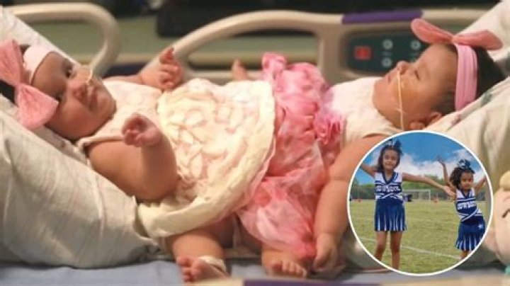 Exploring The Remarkable Lives Of Matthew And Breana Dell: The Conjoined Twins