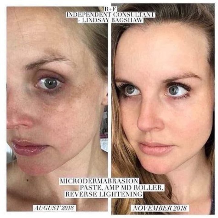 How Microdermabrasion Can Help Get Rid Of Blackheads