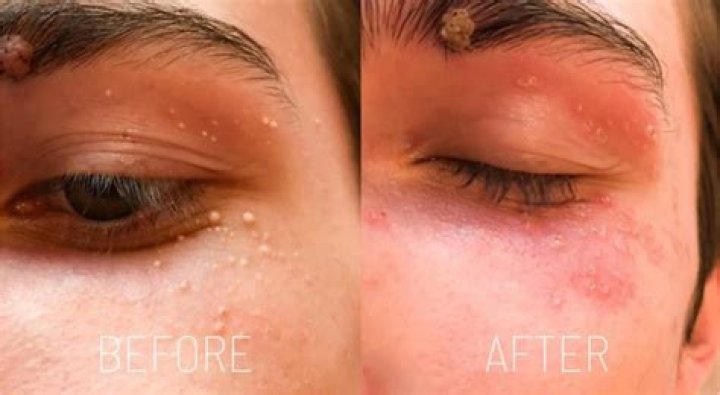 How To Get Rid of Milia, Those Tiny White Bumps