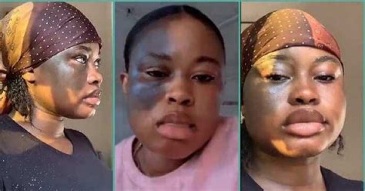 Embracing Uniqueness: The Journey Of A Model With A Face Birthmark
