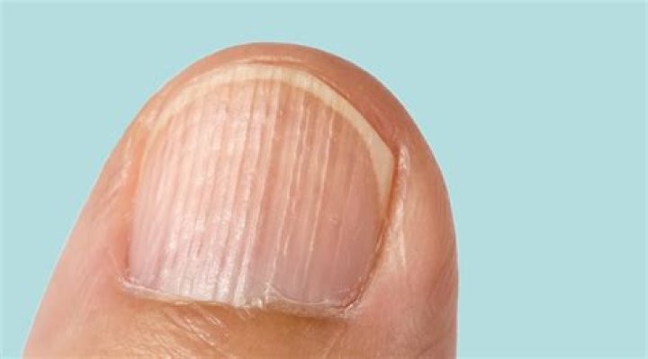 Ridges In Nails: Causes Of Nail Ridges And How To Treat Them