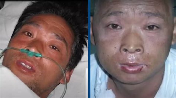 Pictures Of Hisashi Ouchi: The Tragic Story Of A Nuclear Accident Survivor