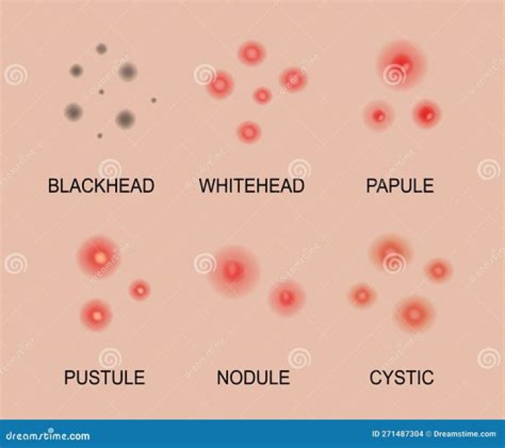 Pimplito: Understanding "Pimple In Spanish" And Its Cultural Significance