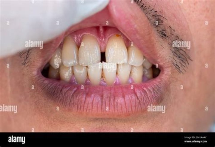 Know about people who have gap between their teeth