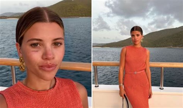 Sofia Richie: The Story Behind The Black Eye
