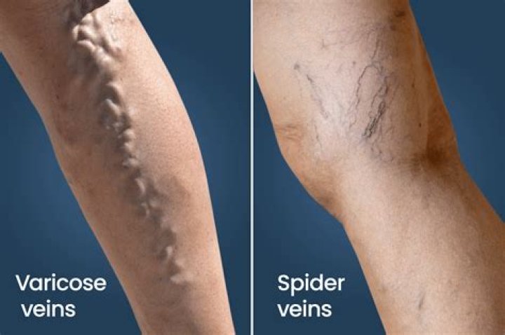 What Are Spider Veins And How Do You Get Rid Of Them?