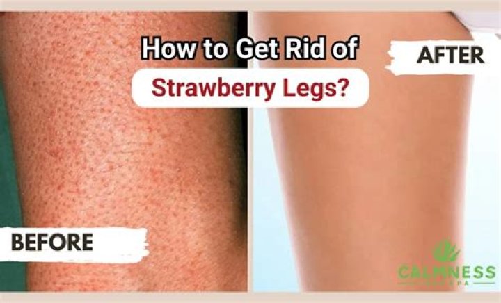 How To Get Rid Of Strawberry Legs - Tips From An Expert