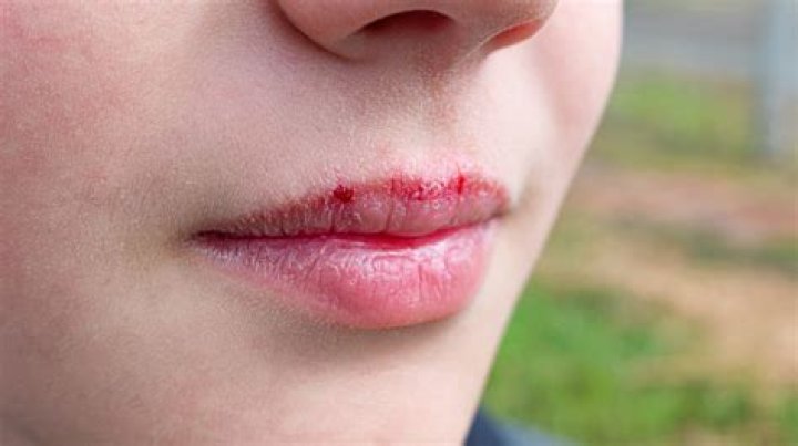 Sunburned Lips, How To Treat It With Expert Advice And Recommendations