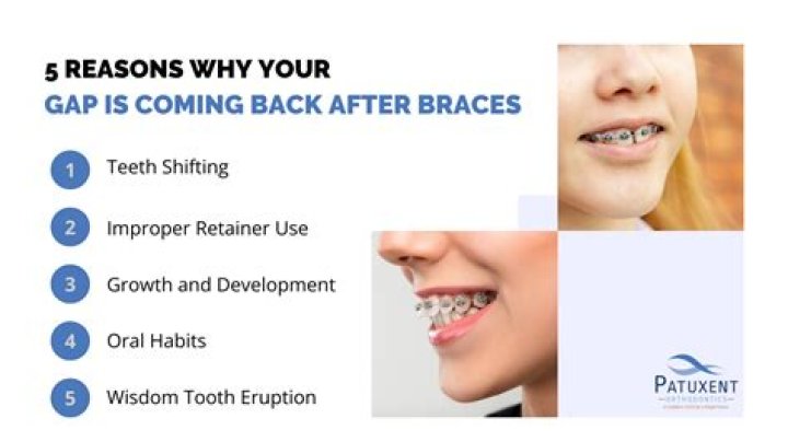 This Product Promises To Fix Your Teeth Gaps Quickly and Safely At Home