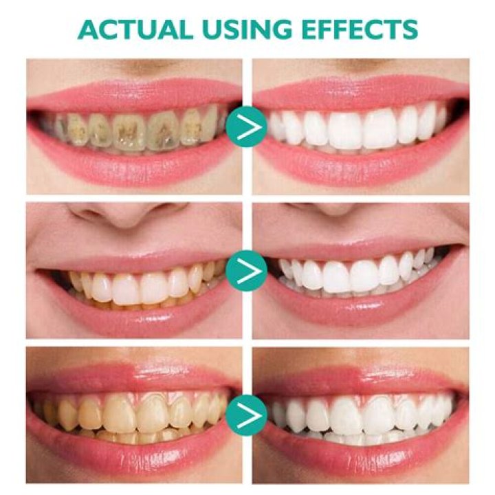 Why You Shouldn't Use Baking Soda For Teeth Whitening