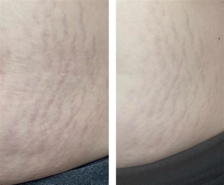 Woman Shares Reality of 150lb Weight Loss With Permanent Deep Stretch Marks