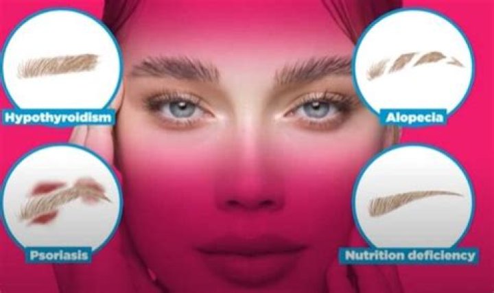 Why You're Getting Spots On Your Eyebrows And How To Treat