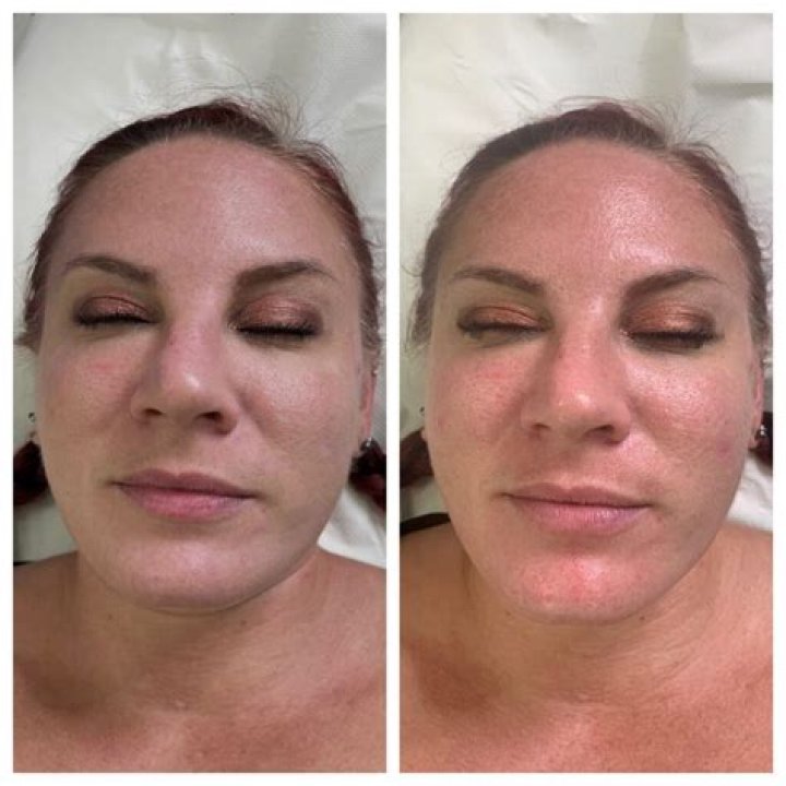 HydraFacial Facials: What Is It, Cost And Skin Benefits