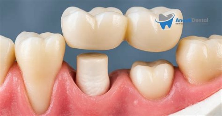 What Is Pontic Porcelain Ceramic