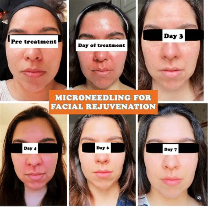 What To Apply After Diy Power Micro Needling