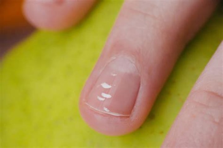 White Spots On Your Nails Causes & How To Get Rid Of Them, ASAP