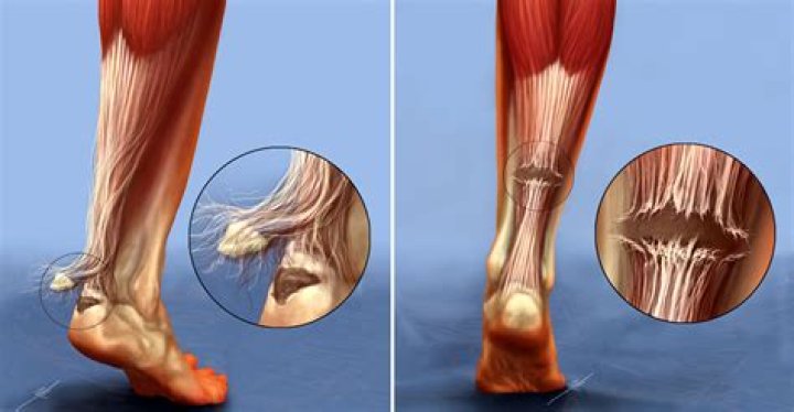 The Ultimate Guide: Can A Torn Tendon Heal Naturally?
